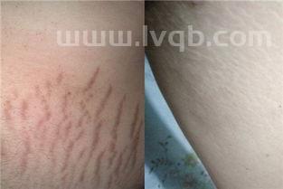 生长纹和肥胖纹的图片对比 有什么区别(肥胖纹初期图片)