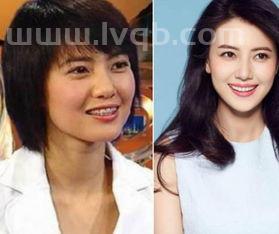 牙齿矫正后脸型会发生变化吗 (正颌手术后脸型改变图)