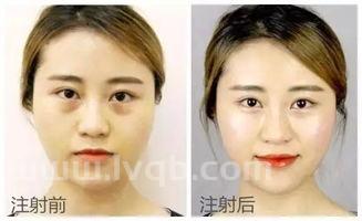 如何去除川字纹 告诉我可以吗 (怎么去川字纹)