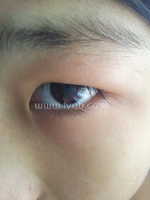 眼睛肿了,怎么快速消肿 (眼睛如何消肿)