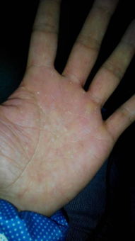 手心手掌奇痒无比是什么原因(手心发痒是什么原因)