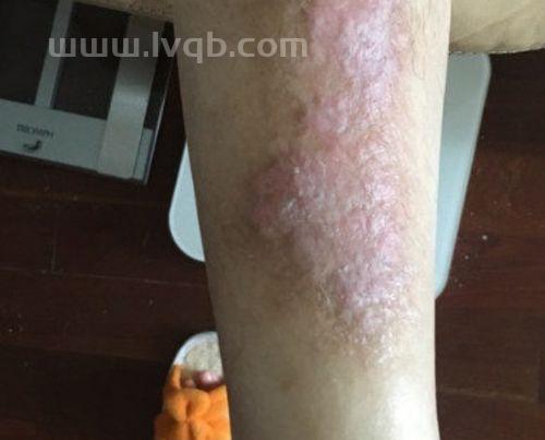慢性湿疹图片,身上长湿疹的图片?湿疹图片?