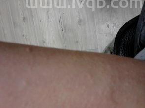 全身痒是怎么回事挠了越抓越痒,皮肤瘙痒越抓越痒是怎么回事?