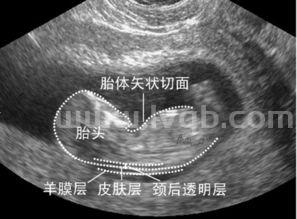 怀孕12周照NT要多少钱(做nt检查需要多少钱)