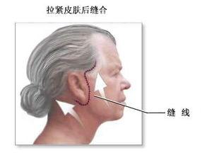 面部整形除皱手术,面部拉皮除皱方法有什么