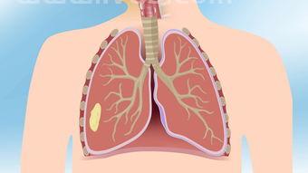 肺结核很容易传染吗 (肺结核传染么)