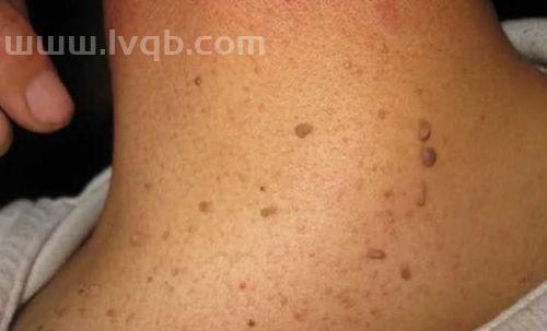 腋下长小肉粒,腋下长了一个肉粒/肉豆,可以拉很长,是什么原因,是否有害?