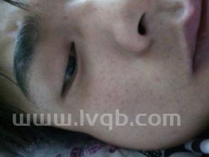 脸上有黑斑怎么消除,去脸上黑斑的最快方法