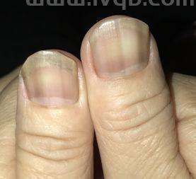 指甲里有短短的黑线怎么回事(指甲里面有黑线是怎么回事)