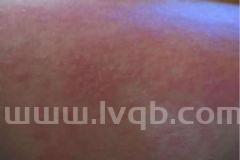 过敏是什么症状,过敏有哪些表现?