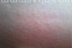 荨麻疹痒怎么缓解,荨麻疹半夜痒如何止痒