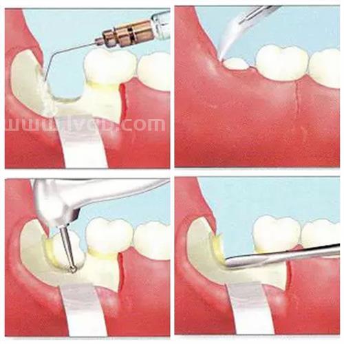 智齿什么时候拔合适拔智齿的最佳时期 急