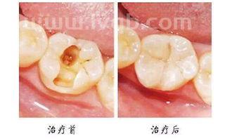 补完牙不能吃什么,补牙期间不能吃什么食物.没有补牙只是在牙洞里放了