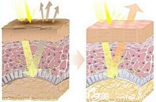 皮肤天生黑可以激光美白吗(激光美白嫩肤)