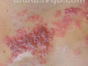 疱疹水泡图片,如何判断得的是带状疱疹?