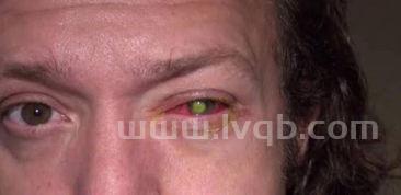 包含戴隐形眼镜睡觉的词条戴隐形眼镜睡觉对眼睛有害吗