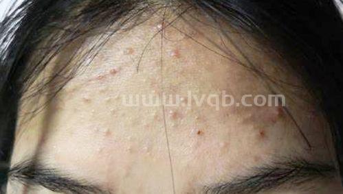 额头长闭口怎么去额头闭口去额头闭口7个小妙招