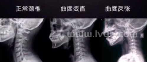 颈椎病分型五种,颈椎病简介