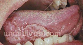 舌癌和舌炎的区别,都有哪些症状(舌癌的图片)