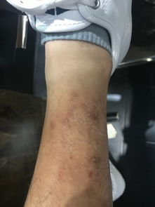 癣病的临床类型及症状(癣的症状图片)